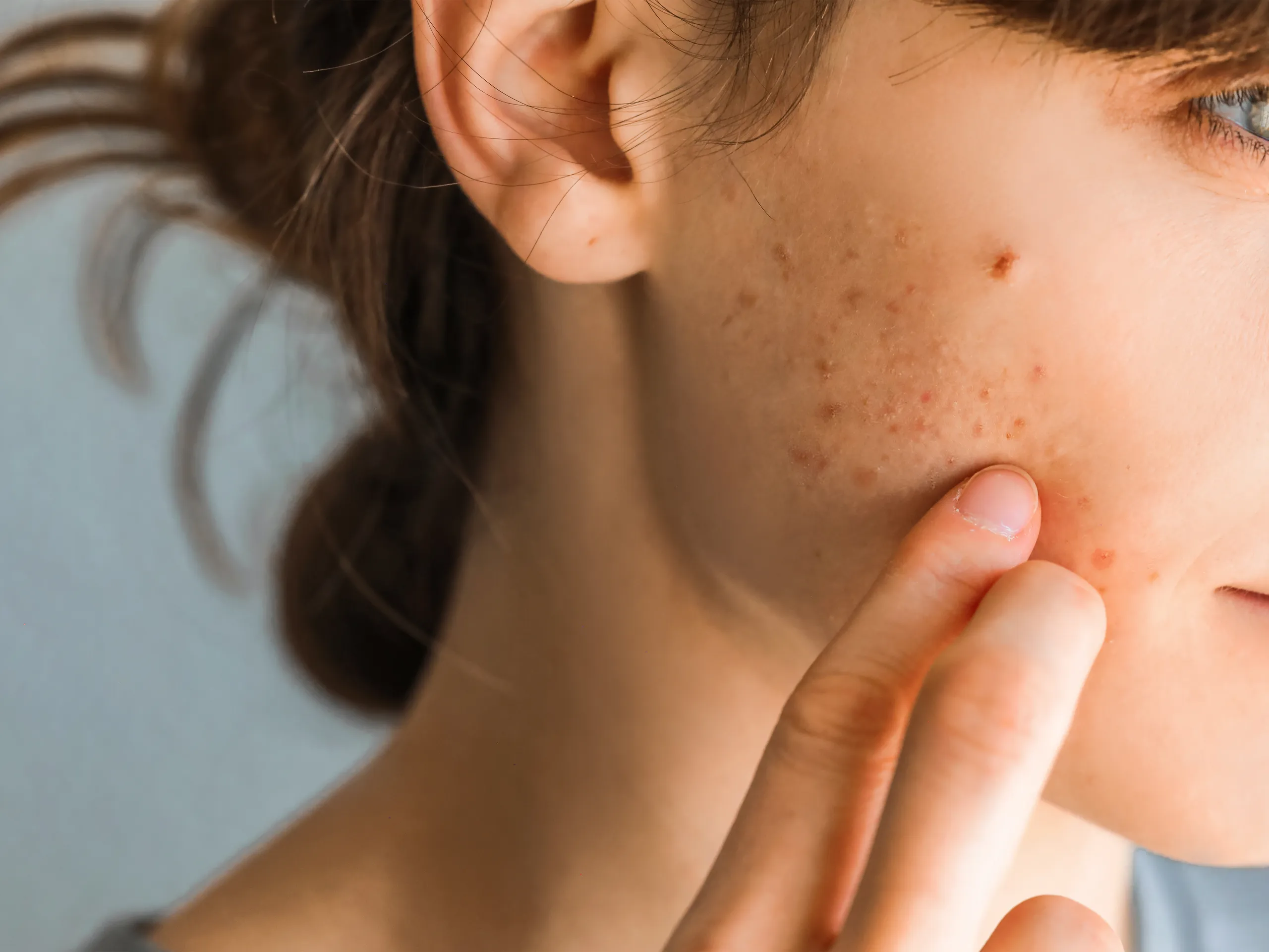 Stop Sekarang! 5 Kebiasaan Skincare Ini Bikin Kulitmu Rusak Diam-Diam