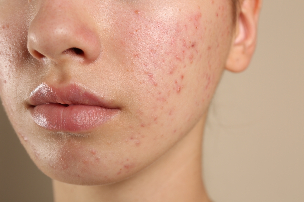 Wajib Tahu! 7 Kandungan Skincare Ini Diam-Diam Bikin Jerawat Makin Ngamuk