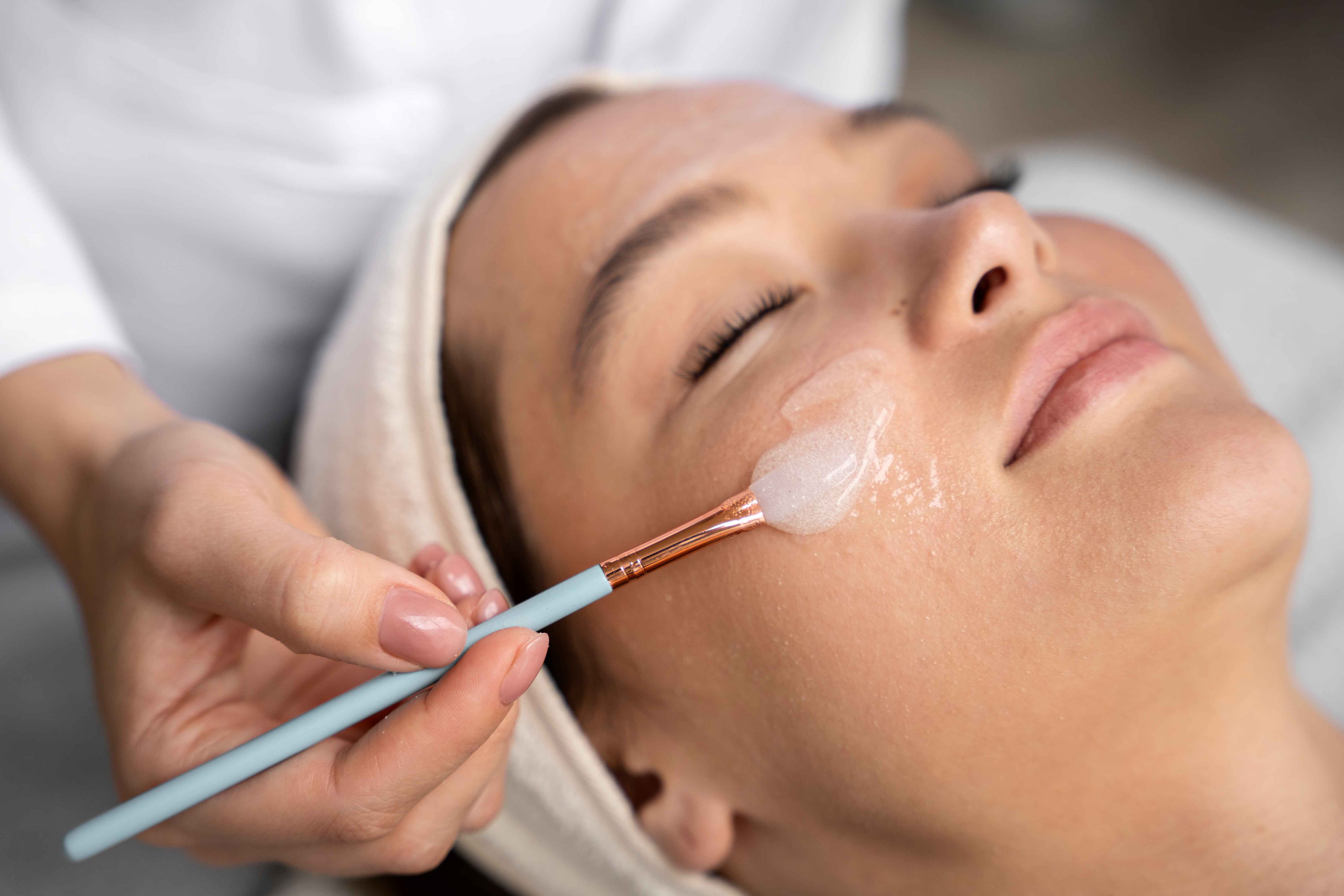 Kulit Kusam atau Berjerawat? Ini Saat yang Tepat untuk Chemical Peeling