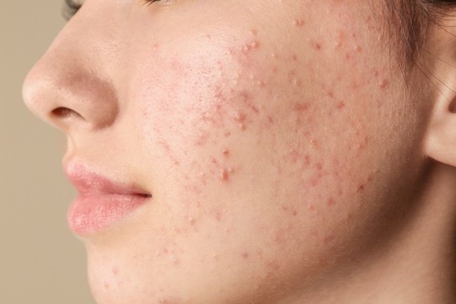 Beruntusan? Ini 7 Cara Ampuh dan Cepat Mengatasinya Agar Wajah Kembali Cantik