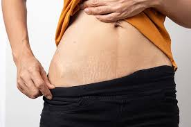 Gak Perlu Mahal! Begini Cara Memudarkan Stretch Marks dengan Bahan Rumah Tangga