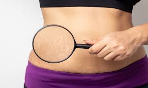 Benarkah Baby Oil Bisa Menghilangkan Stretch Mark? Simak Penjelasannya!