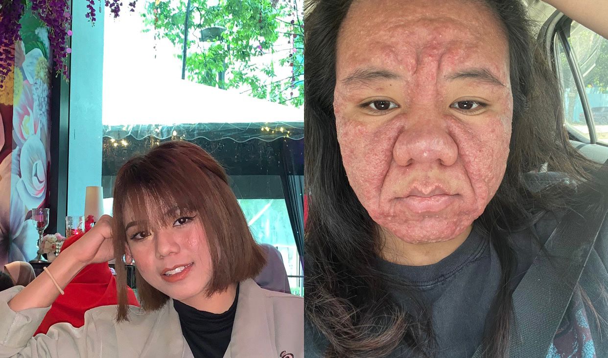 Alami Perubahan Wajah Ekstrem Saat Hamil, Wanita Asal Malaysia Ini Bagikan Pengalamannya