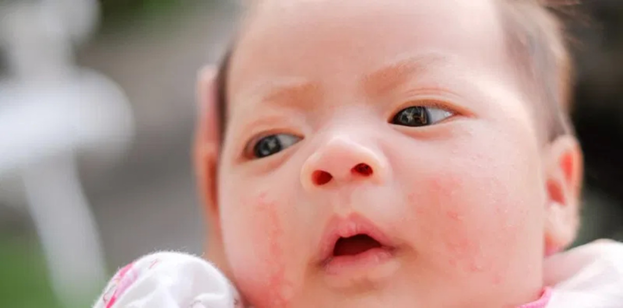 6 Jenis Ruam yang Sering Muncul pada Bayi, Kapan Harus ke Dokter?