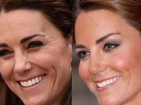 Wajah Sempurna Kate Middleton Picu Isu Operasi Plastik: Botox, Payudara, Capai Biaya Miliaran Rupiah!