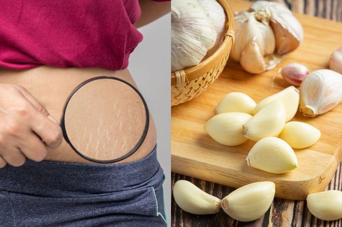 No Klinik, No Repot! 7 Bahan Dapur Ini Ampuh Bikin Stretch Mark Pudar dalam Hitungan Minggu!