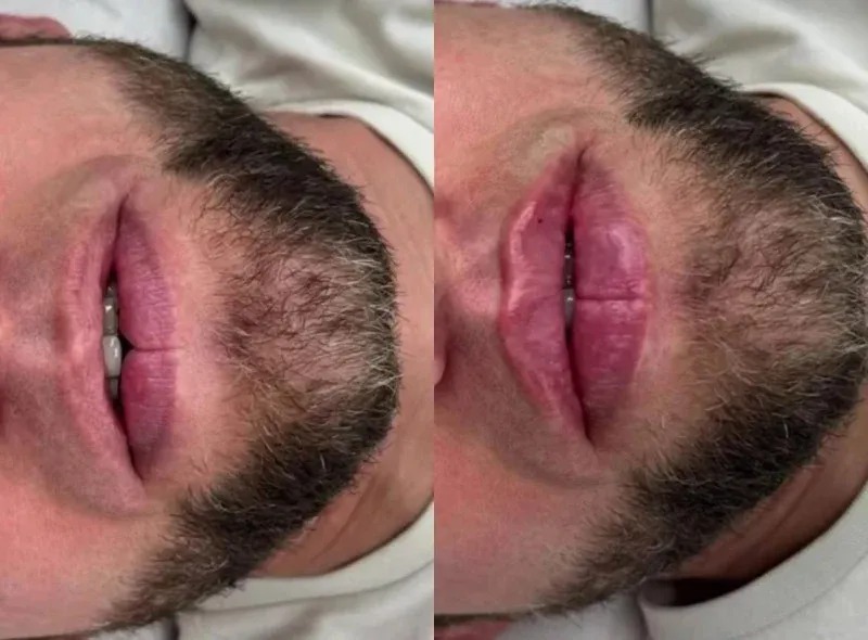 Heboh! Tren Pria Suntik Filler Bibir Tengah Malam di Rusia, Demi Maskulinitas atau Lawan Budaya?