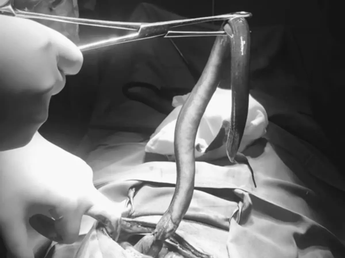 Ngeri! Belut Hidup Sepanjang 30 Cm Berenang di Perut Seorang Pria, Dokter Ungkap Penyebabnya