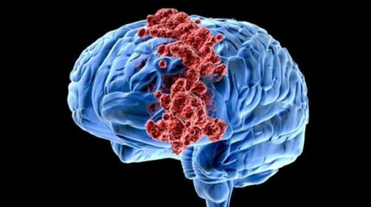 Jangan Anggap Sepele! Ini Gejala Awal Tumor Otak yang Sering Diabaikan