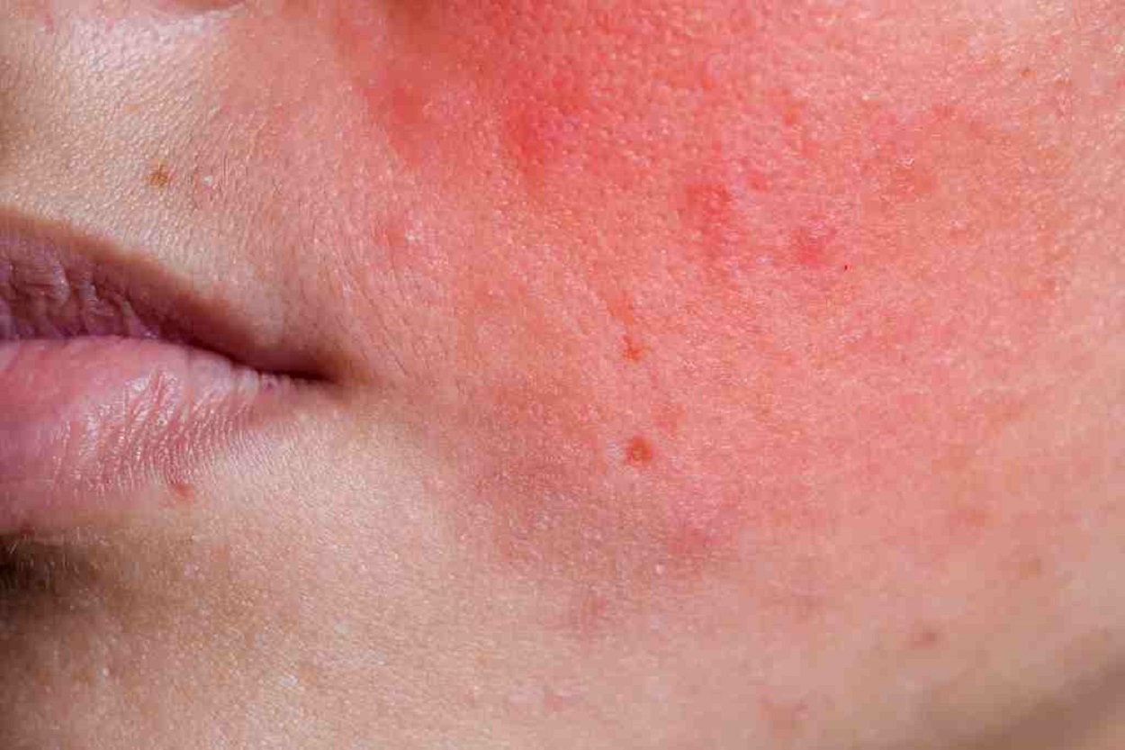STOP Asal Pakai Skincare! Ini Alasan Kenapa Kulit Bisa Jadi Sensitif Mendadak