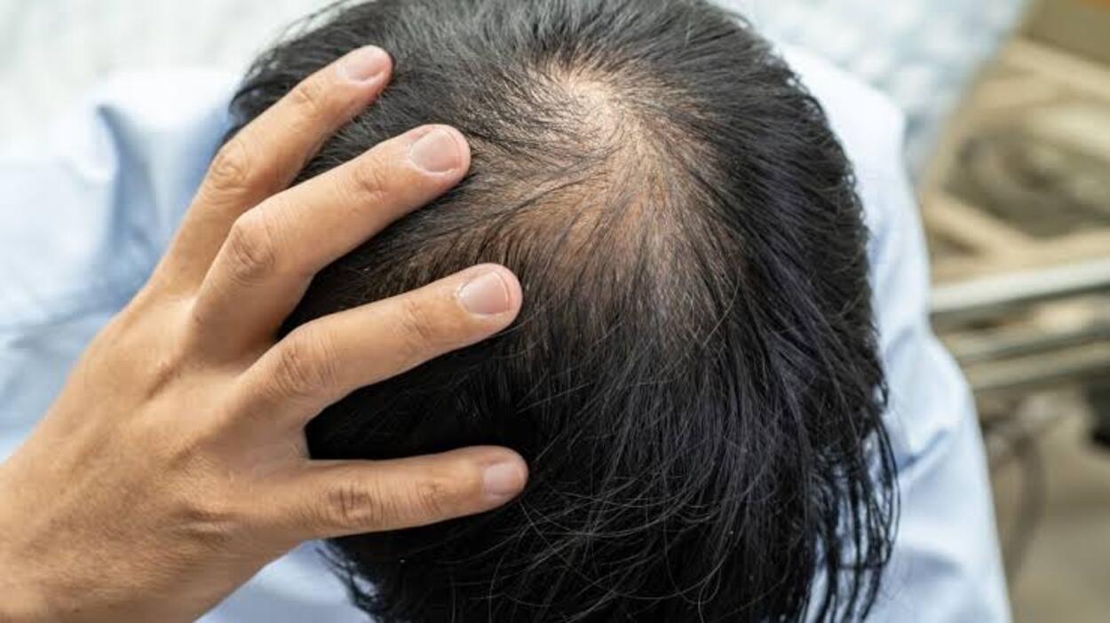 Nggak Nyangka! 5 Makanan Sehari-hari Ini Bisa Bikin Rambut Rontok Parah