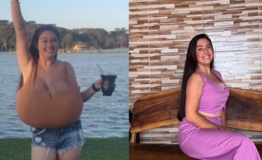 Payudara Terus Membesar Hingga Berat 11 Kg, Hidup Wanita Ini Jadi Mimpi Buruk! Gigantomastia Bikin Sakit, Malu, dan Hampir Lumpuh