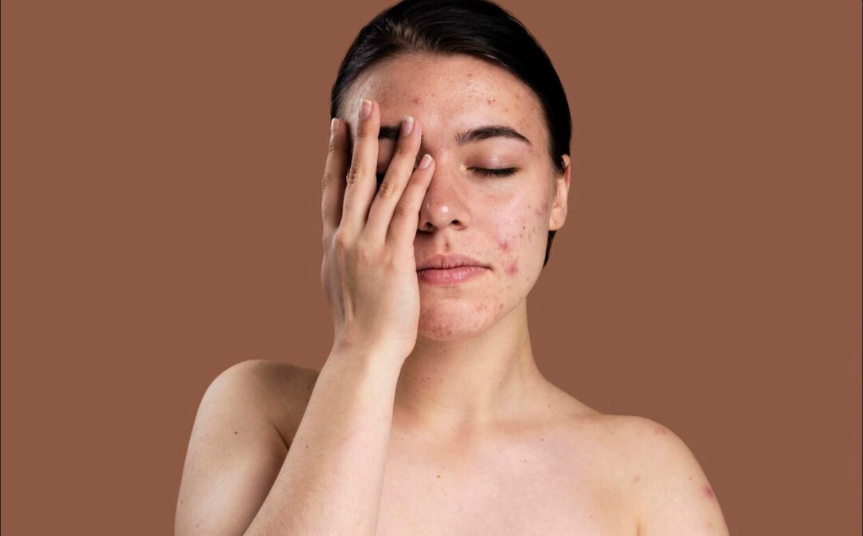 Acne Patch Jadi Solusi Andalan Atasi Jerawat Cepat dan Praktis, Ini 4 Rekomendasi Merk Terbaiknya!