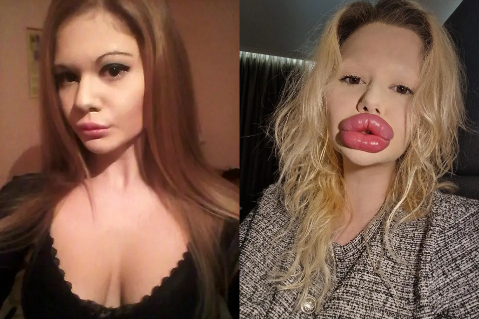 Kecanduan Filler! Transformasi Ekstrem Wanita dengan Bibir Terbesar di Dunia yang Bikin Syok