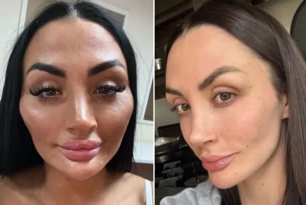 Obsesi Kesempurnaan Instan, Tren ‘Love Island Face’ Dianggap Simbol Kecantikan yang Menyeramkan!
