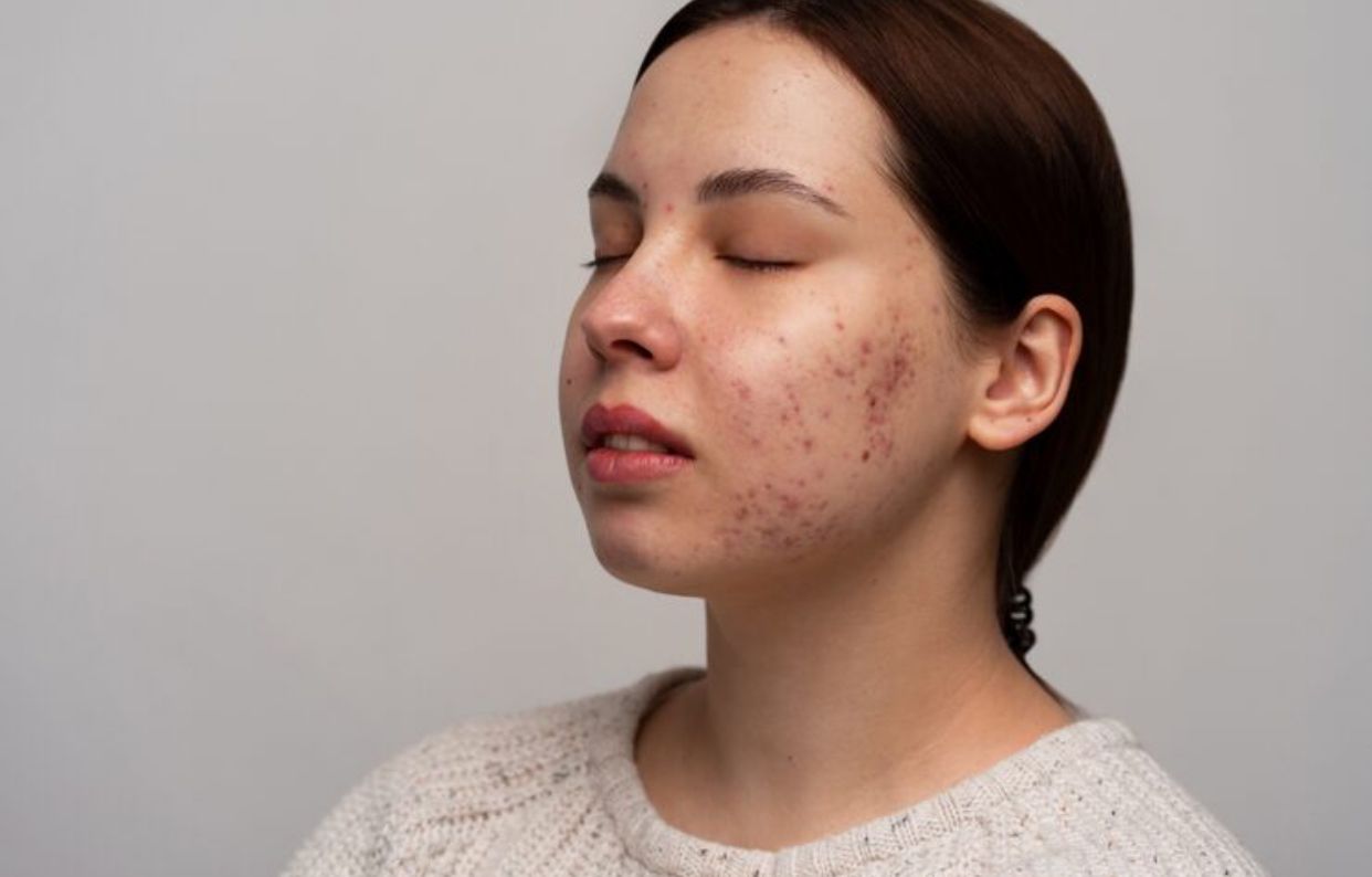Flek Hitam Membandel Tak Kunjung Hilang? Ini Kesalahan Skincare yang Justru Bisa Memperparah 