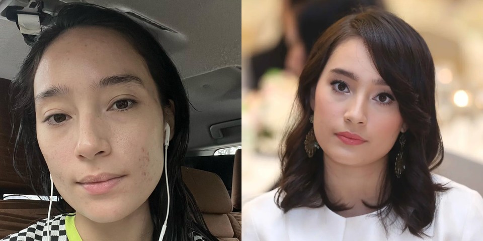 Terlihat Sempurna, Tatjana Saphira Ternyata Pernah Insecure Karena Jerawat! Ini Perjuangannya Selama 10 Tahun