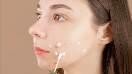 Tips Ampuh Hilangkan Bekas Jerawat dengan Bahan Dapur!