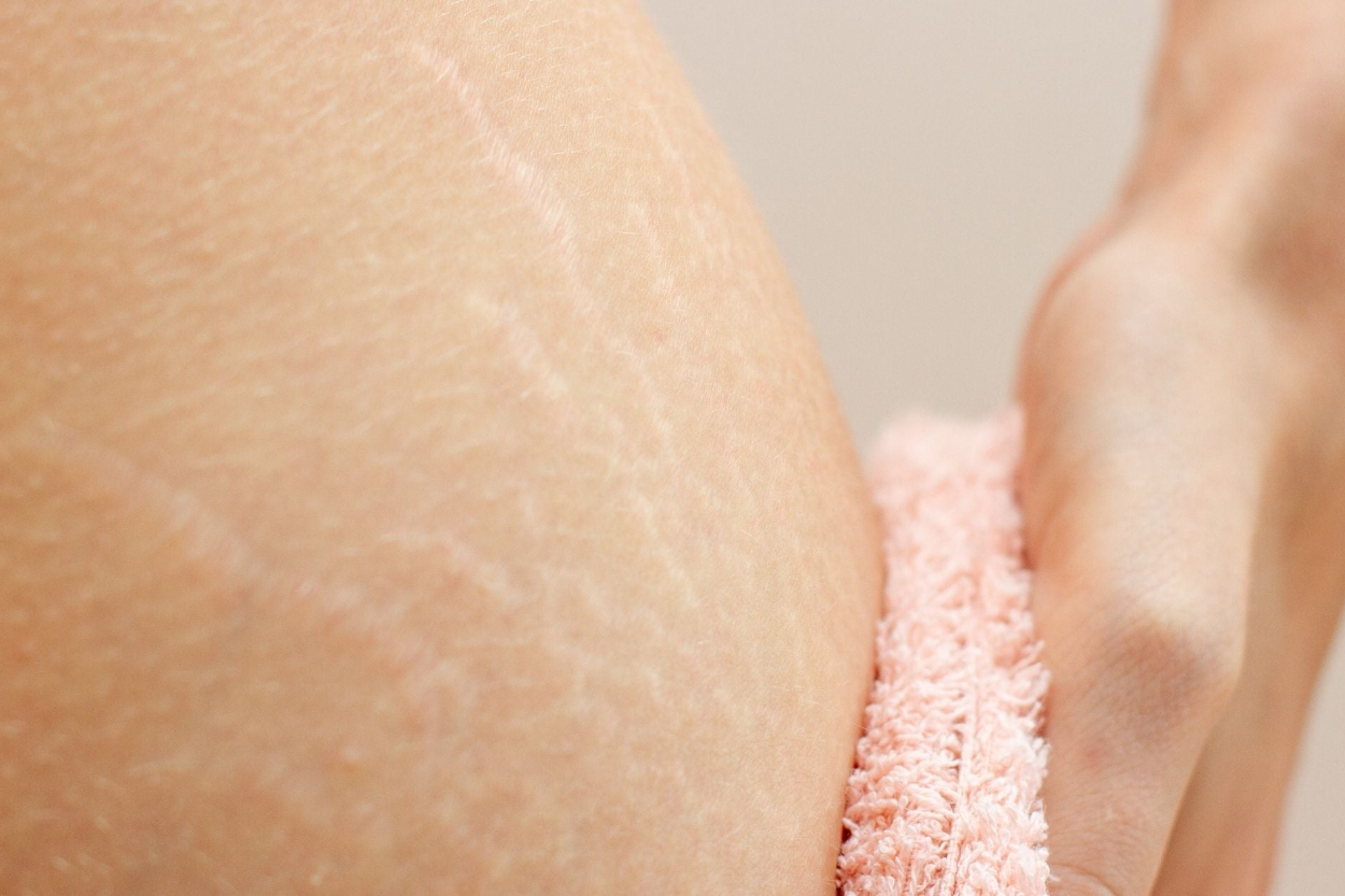 Tidak Bisa Hilang Total! Ini Fakta Stretch Mark dan 5 Cara Ampuh Menyamarkannya Secara Medis Maupun Alami