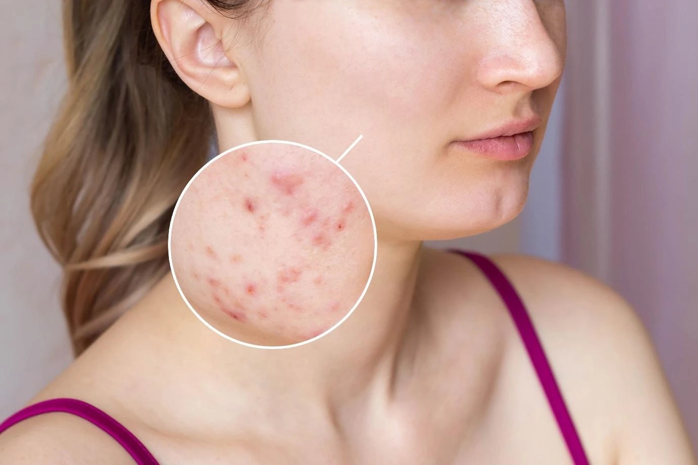 Awas Fungal Acne Bisa Menyerang Siapa Saja dan Lebih Berbahaya dari Jerawat, Kenali Sebelum Terlambat