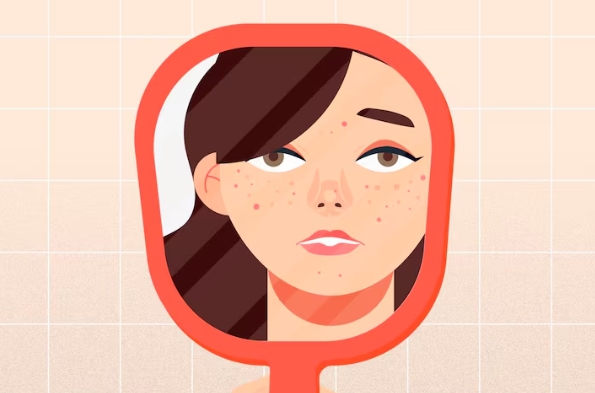 Ada Jerawat di Tengah-Tengah Kening? Jangan Dipencet, Ini Alasannya!