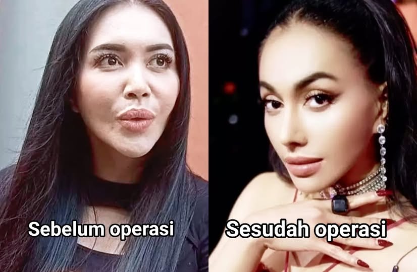 Perbedaan Mencolok Denada Sebelum dan Sesudah Operasi Plastik Tuai Sorotan, Lebih Cantik Mana?