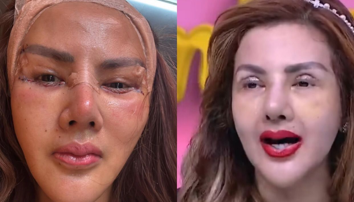 Delapan Kali Operasi Plastik, Barbie Kumalasari Tampil Mirip Kylie Jenner