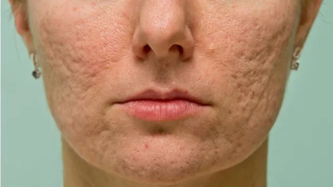 Tips Hilangkan Bopeng Bekas Jerawat, hanya dengan Skincare?