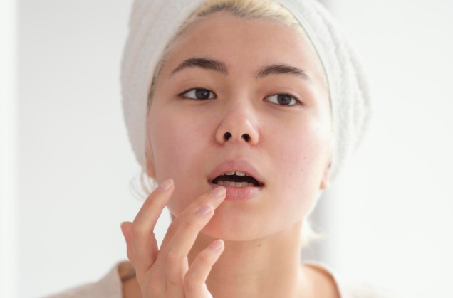 Jerawat di Bibir Bikin Risih? Begini Cara Mengatasinya!
