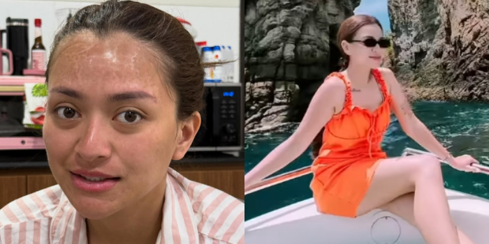 Kulit Nathalie Holscher Melepuh Karena Sunburn, Kenali Cara Pencegahan dan Pengobatannya!