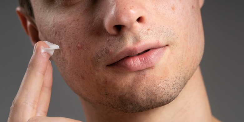 Jangan Asal Pakai! Cara Memilih Sunscreen yang Tepat untuk Kulit Berjerawat
