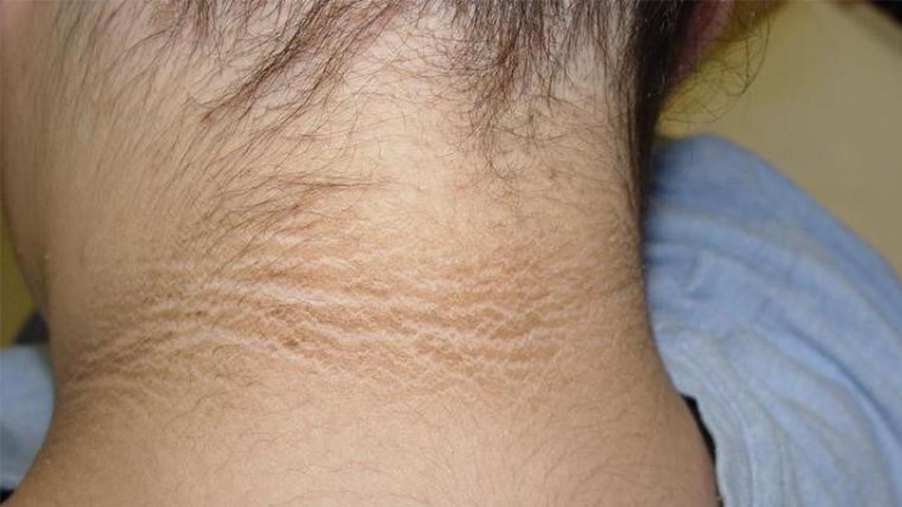 Dijamin Efektif, Cara Menghilangkan Daki di Tengkuk yang Membandel dengan Bahan Alami