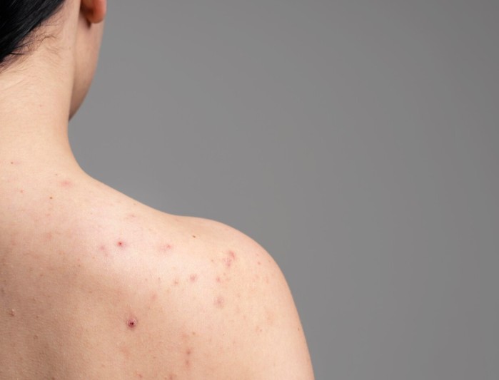 Bye-Bye Bacne! Cara Ampuh Mengatasi Jerawat Punggung dengan Mudah