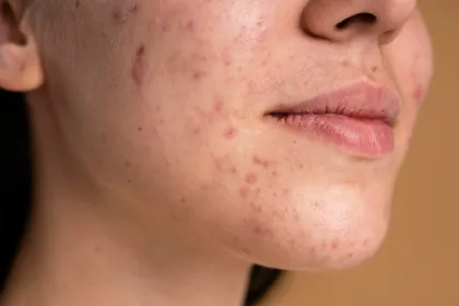 Rekomendasi Skincare untuk Memudarkan Bekas Jerawat: Panduan Lengkap dan Pilihan Produk 2026