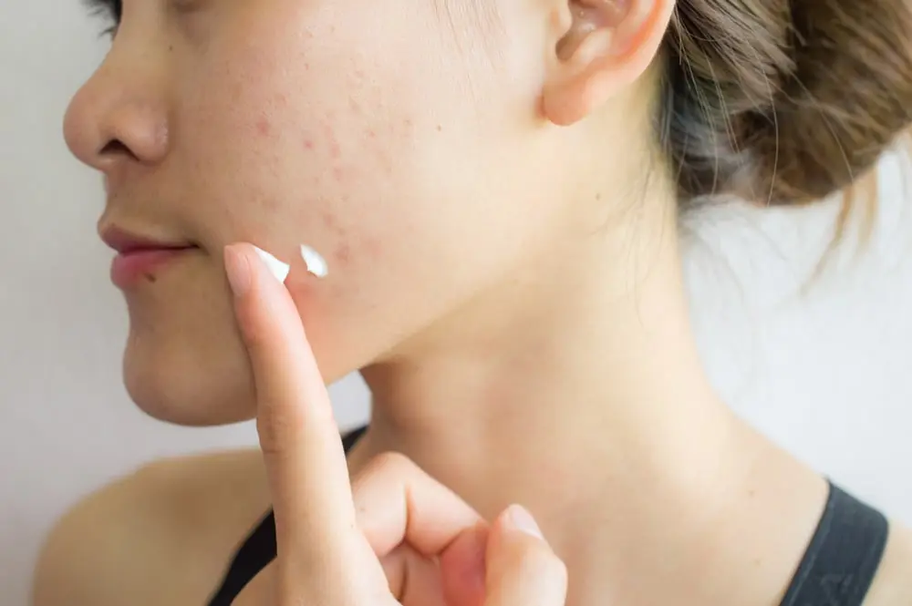 Masih Banyak yang Salah Kaprah! Kulit Berjerawat Ternyata WAJIB Pakai Moisturizer, Ini Alasannya