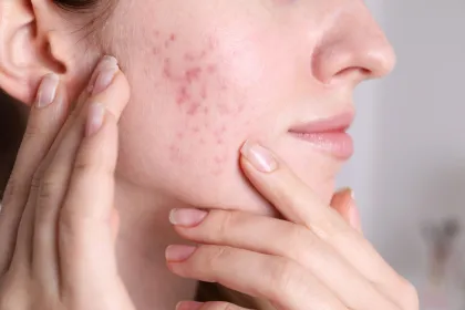 10 Masker Wajah untuk Kulit Berjerawat, Jadi Senjata Rahasia Kulit Mulus Tanpa Drama