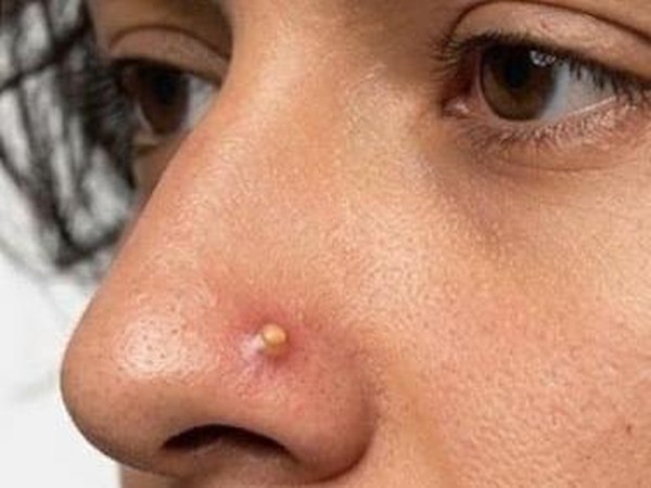 Tren Jerawat Palsu di Hidung Bikin Netizen Jijik Sekaligus Penasaran, Tertarik Coba?