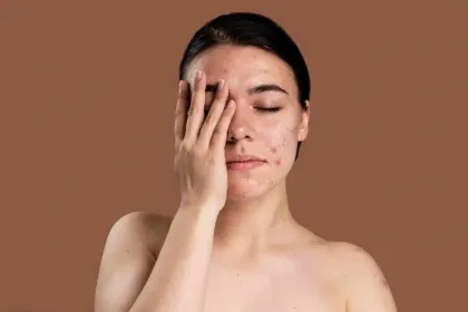 6 Cara Ampuh Redakan Jerawat Meradang Sebelum Makin Parah!