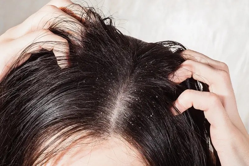 Lawan Ketombe dan Rambut Rontok, Ini Cara Ampuh yang Wajib Dicoba Biar Rambut Makin Lebat
