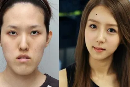 Mau Operasi Plastik di Korea Selatan? Catat 5 Tips Penting Ini Biar Nggak Salah Klinik dan Nyesal Seumur Hidup!