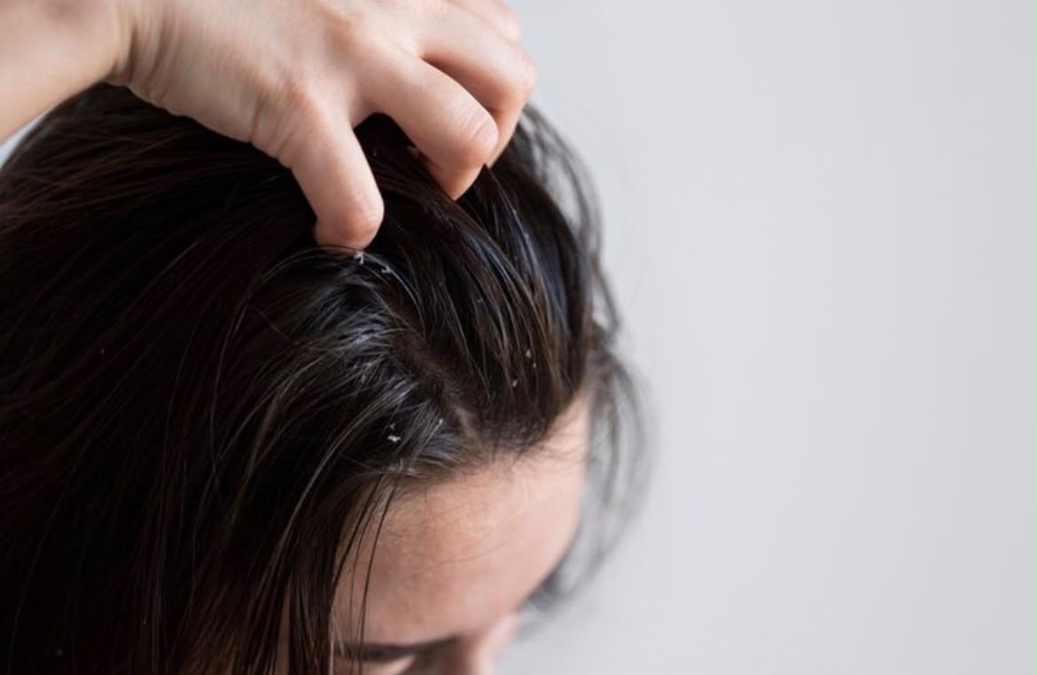 5 Cara Mengatasi Rambut Lepek Tanpa Harus Sering Keramas