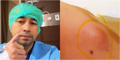 Mengenal Lipoma Seperti yan...