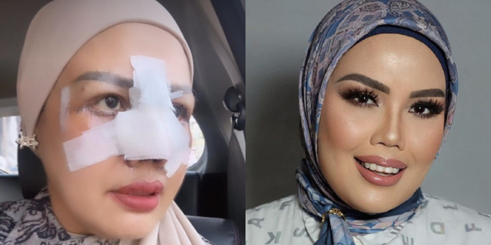 Elly Sugigi Nekat Jalani Op...
