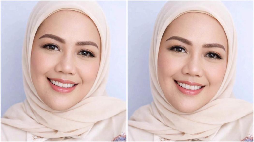 Usai Oplas Hidung, Elly Sug...