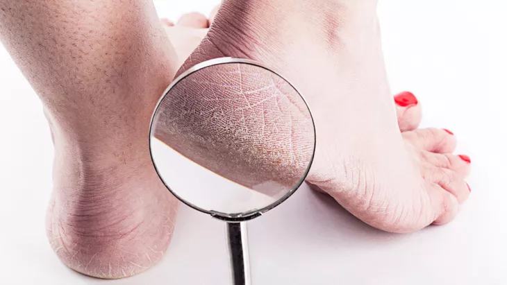 Tumit Pecah-Pecah Tak Kunjung Sembuh? Coba 5 Bahan Alami yang Ampuh Mengembalikan Kelembapan Kulit