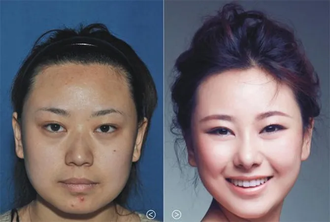 Mulai Tinggalkan V-Shape, Ini 5 Tren Oplas Paling Populer di China Tahun 2026