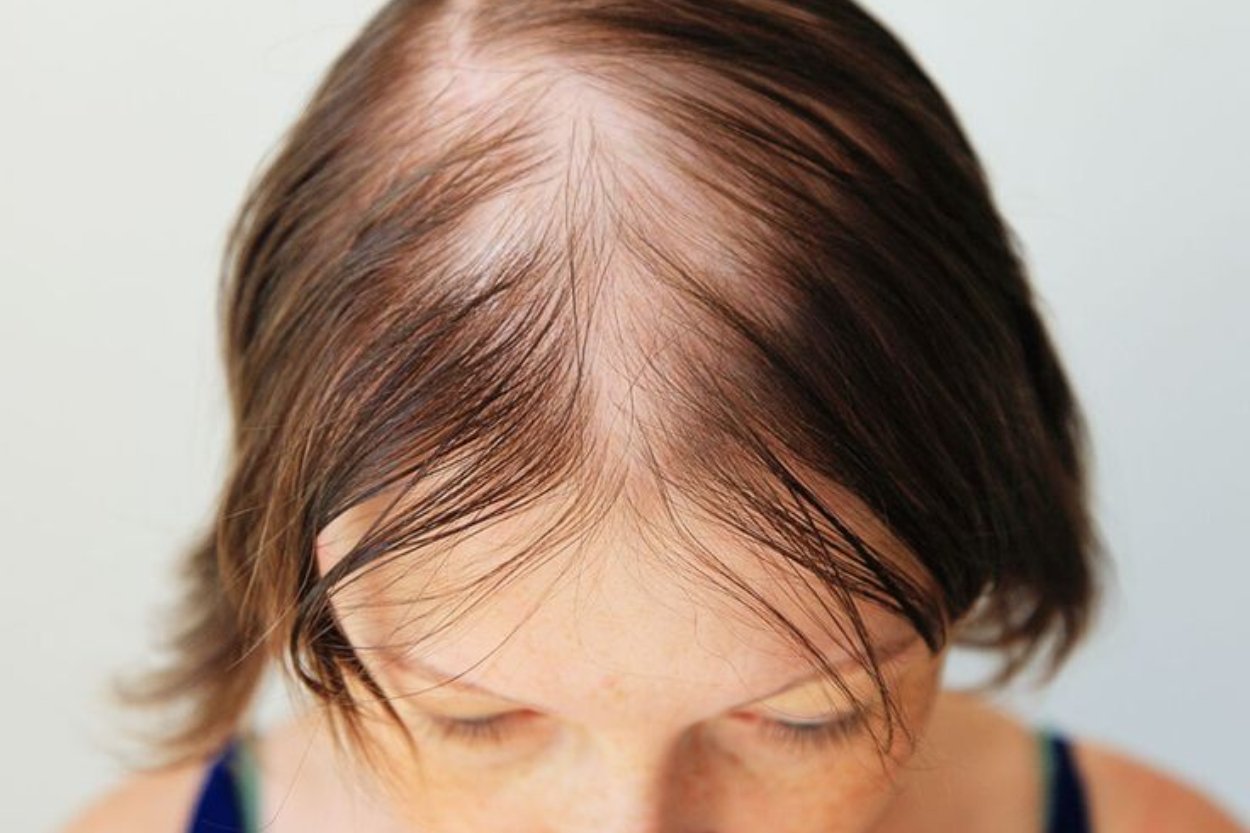 5 Penyebab Rambut Menipis: ...