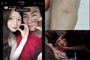 Bukti Kekerasan Hong Min Gi Terungkap, Mantan Pacar Unggah Foto Memar hingga Kolaps