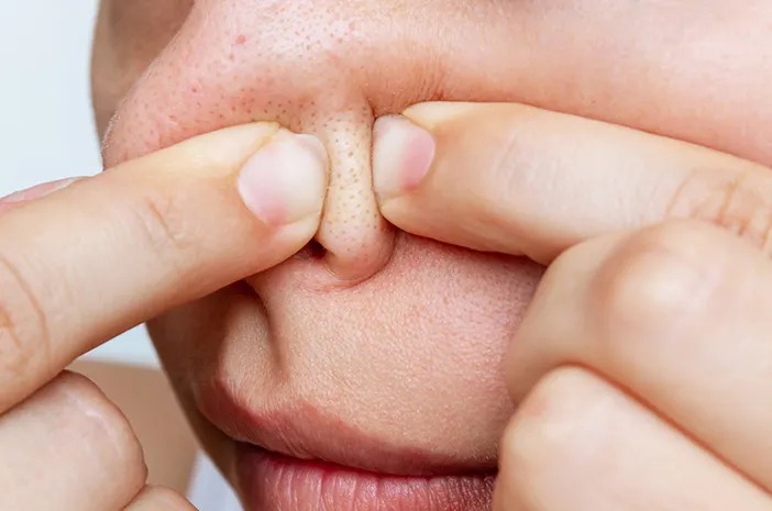 Komedo di Hidung Tak Kunjung Hilang? Ini Cara Ampuh dan Kesalahan Fatal yang Harus Dihindari