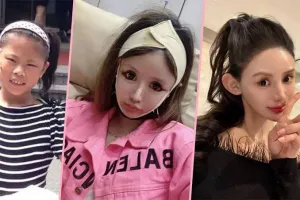 Gara-Gara AI, Makin Banyak Pasien Oplas Ingin Wajah Cantik Tak Realistis